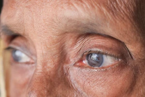 Œil d'une personne âgée atteint de cataracte